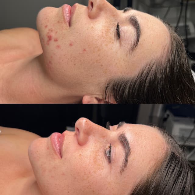 Clear Skin Jumpstart at Wendy Will Esthetics in Culver City, CA