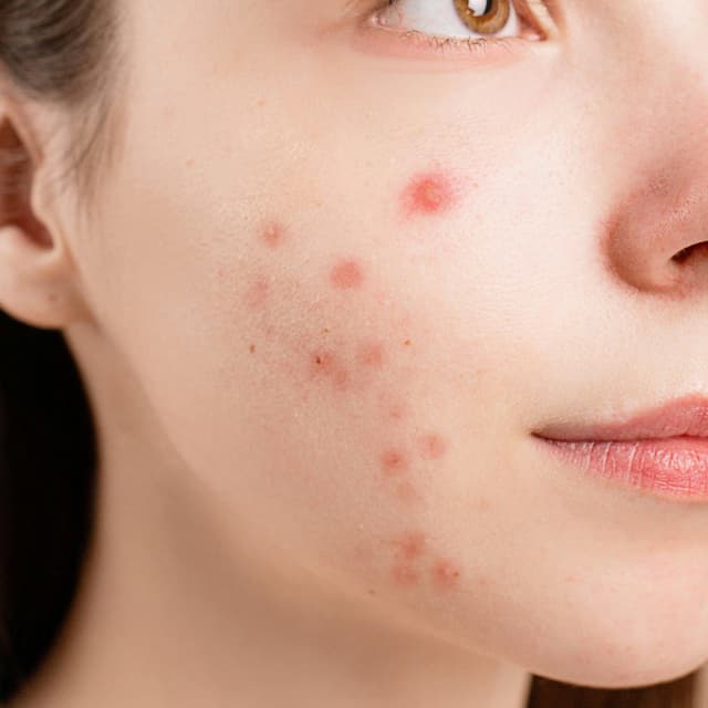 Clear Skin Monthly Plan at Wendy Will Esthetics in Culver City, CA